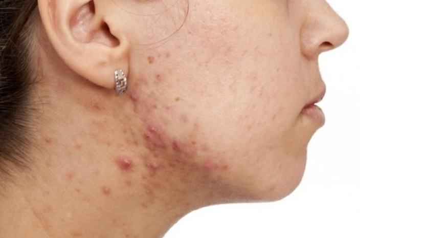 what food causes acne on jawline