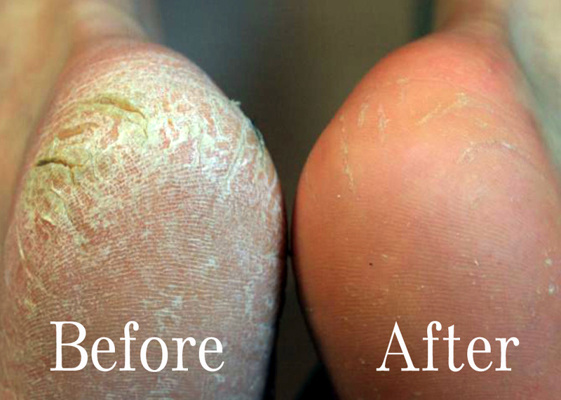 remove hard skin from foot