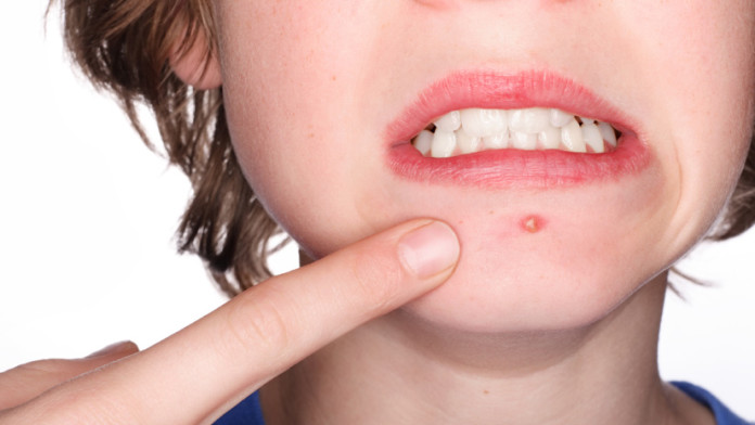 Home-Remedies # 2: Pimples