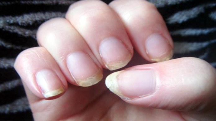 Brittle Nails: Home Remedies