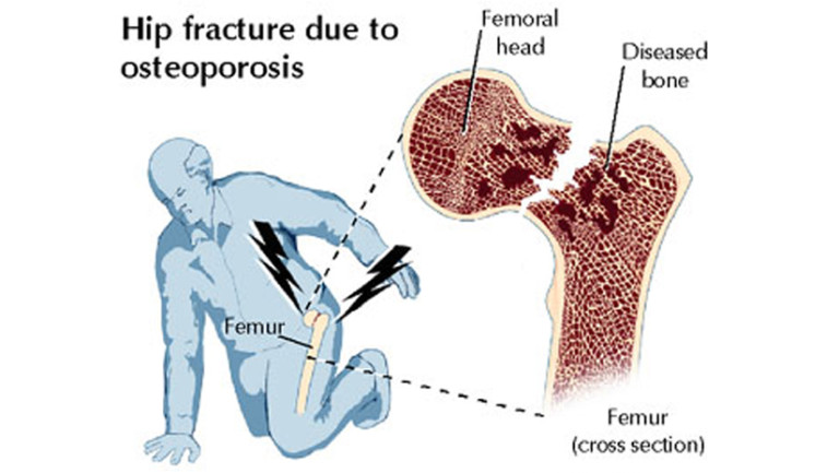 Osteoporosis | Causes & Symptoms - FunBuzzTime