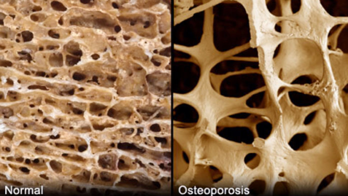 Osteoporosis | Causes & Symptoms