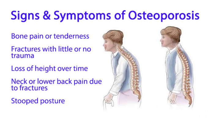 Osteoporosis | Causes & Symptoms - FunBuzzTime