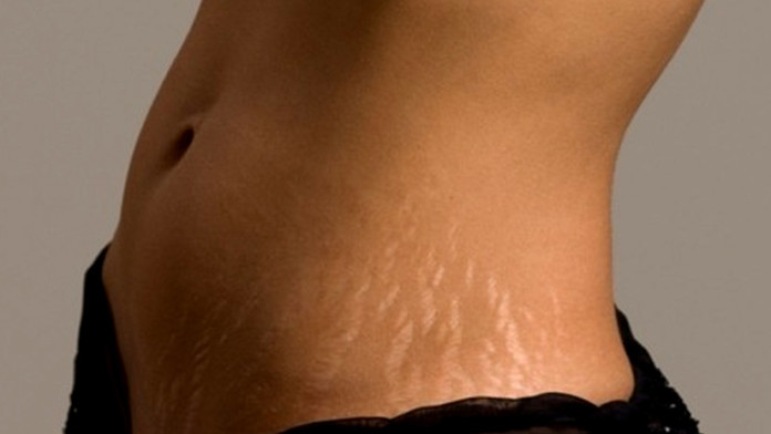 Stretch Marks | Getting Rid of Them