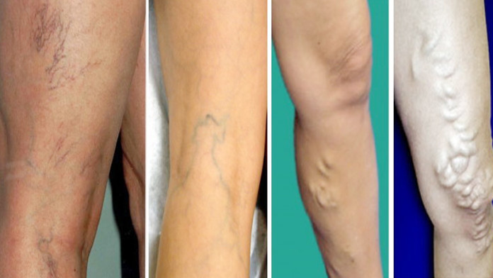 Varicose Veins | Guide to Take Care