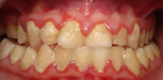 dental-biofilms-oral-health