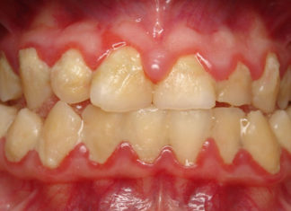 dental-biofilms-oral-health