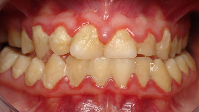 dental-biofilms-oral-health